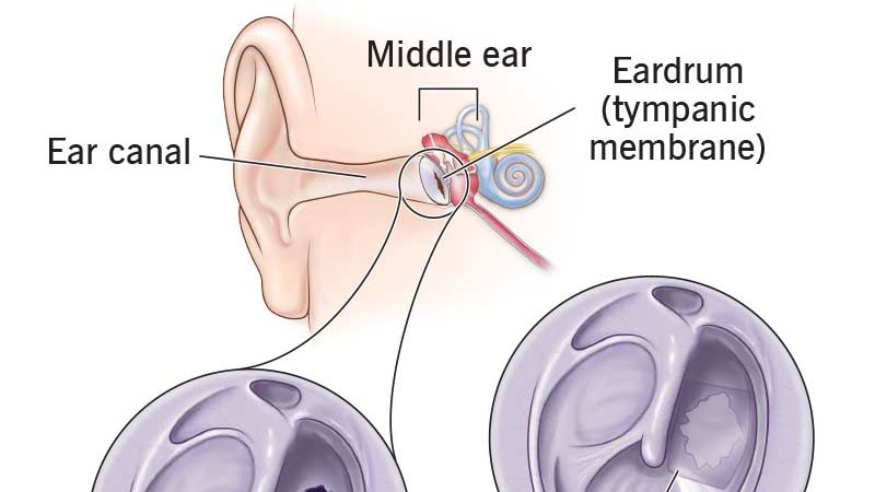 24406-tympanoplasty.jpg