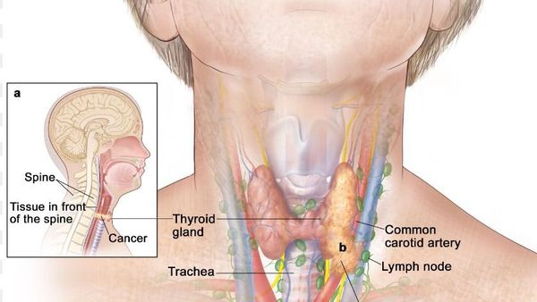 سرطان تیروئید : علائم و خطرات