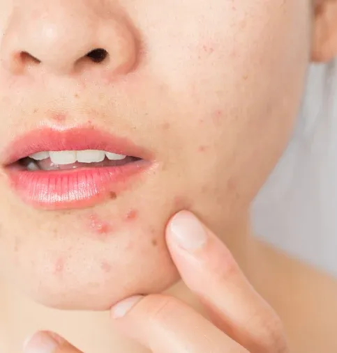 درمان بیماری های پوستی