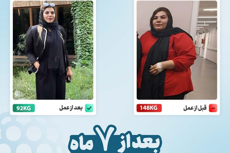 عکس قبل و بعد از عمل اسلیو معده بیمار دکتر کیانی