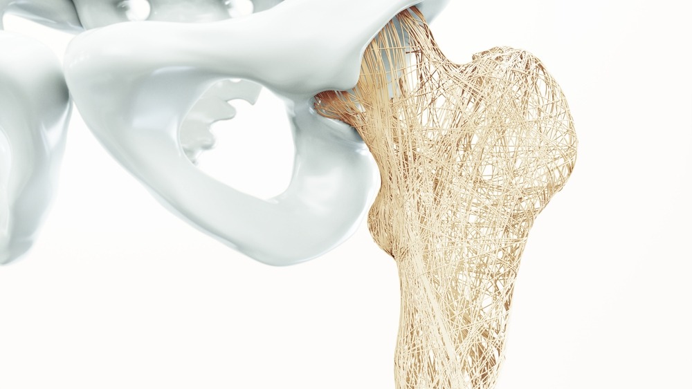 69f1b6652c523541-109ef85cb98c-Osteoporotic-hip-shutterstock_524340781.jpg