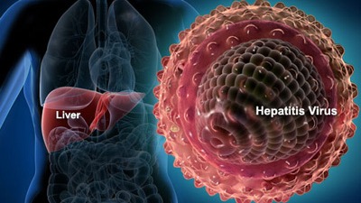 Severe acute hepatitis of unknown etiology in children in 2022: A