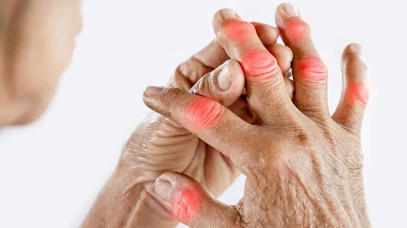 درمان آرتروز دست(کف دست و انگشتان):