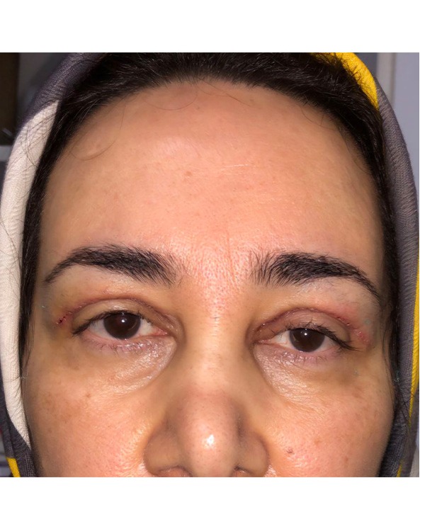 جراحی بلفاروپلاستی