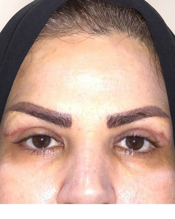 جراحی بلفاروپلاستی