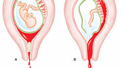 چگونه ازسقط جنین پیشگیری کنیم؟