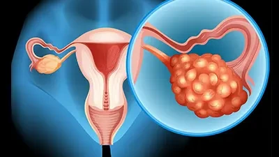 سندروم تخمدان پلی کیستیک(pcos):