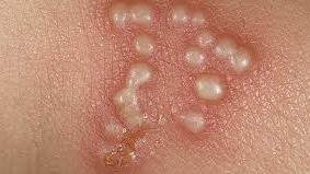 hsv (تبخال تناسلی)