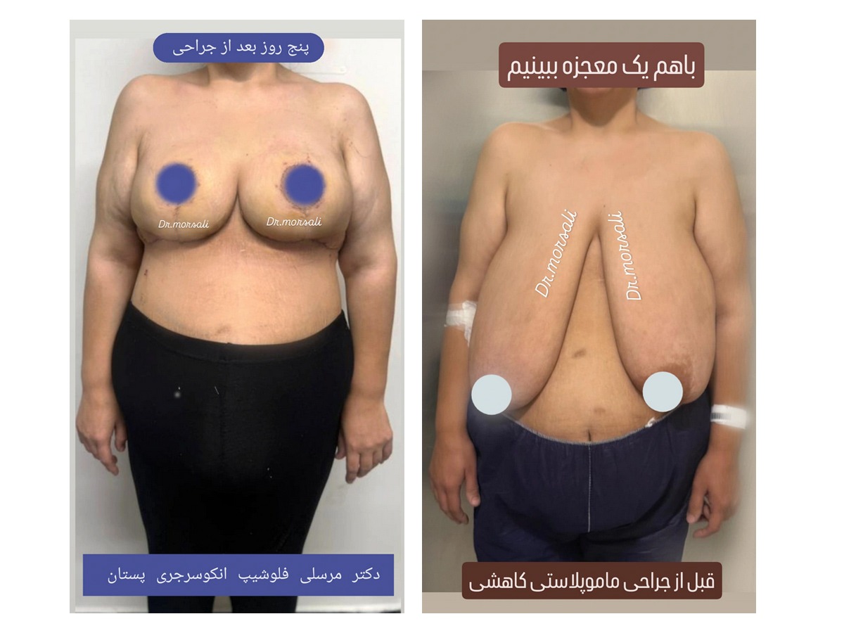 نمونه کار جراحی ماموپلاستی کاهشی توسط دکتر زینب مرسلی فوق‌تخصص جراحی پلاستیک پستان
