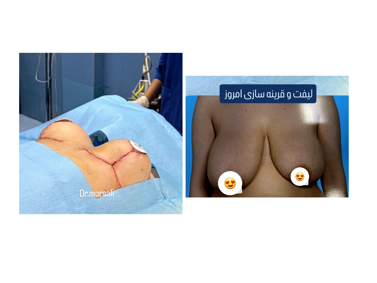 نمونه کار جراحی لیفت و قرینه سازی توسط دکتر زینب مرسلی فوق‌تخصص جراحی پلاستیک پستان