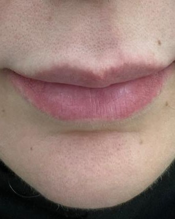 فیلر لب